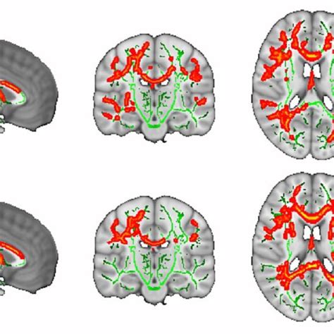 Vbm Whole Brain Morphological Alterations In The Ageing Brain Reduced