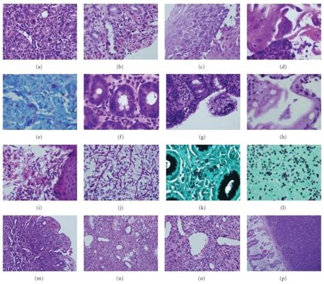 Histopathologic features of HIV-associated GI pathology. (a) CMV ...