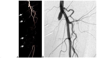 Fluoroscopic Images A Demonstrating Percutaneous Transluminal