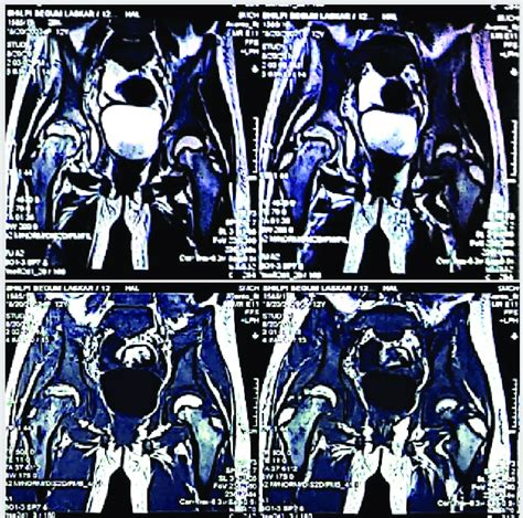 B Pre Operative Contrast Magnetic Resonance Imaging Mri Of Both