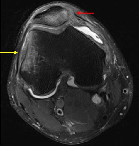 Medial Patellar Retinaculum Injury