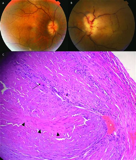 Color Fundus Photograph Of The Right Eye Showing A Blurred Margin Optic