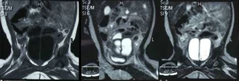 Magnetic Resonance Imaging Mri Of The Pelvis Showed A Septated Pocket