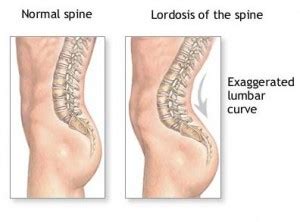 Lordosis Treatment in Singapore | Orthopaedic Clinic Singapore