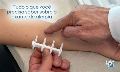 Tudo O Que Voc Precisa Saber Sobre O Exame De Alergia Alergocl Nica