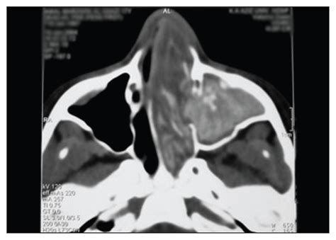 Allergic Fungal Sinusitis Radiological And Microbiological Features Of