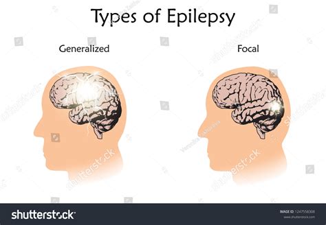 Types Epilepsy Vector Medical Illustration Generalized Stock Vector Royalty Free 1247558308