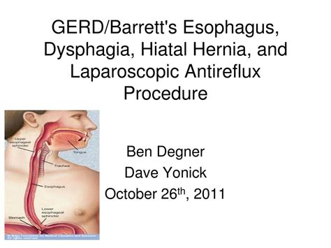 Ppt Gerdbarretts Esophagus Dysphagia Hiatal Hernia And