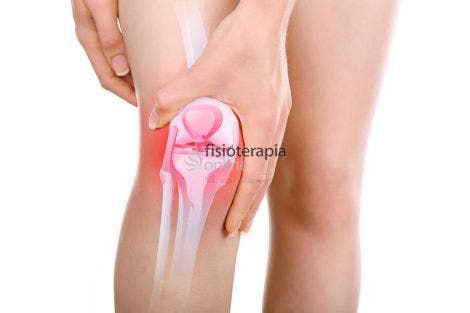 Qu Es Una Bursitis De Rodilla Causas Diagn Stico Y Tratamiento En