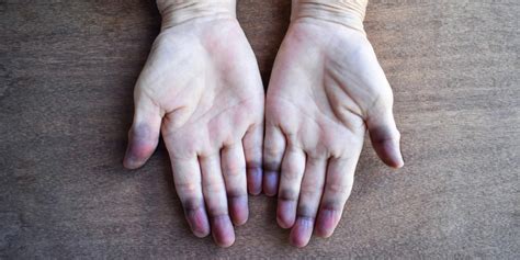 raynaud disease  phenomenon whats  difference