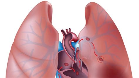 Que Es Una Trombosis Pulmonar Papel De La Ecocardiografia