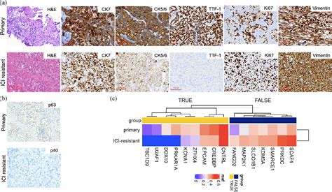 Figure 1 From Histological Sarcomatoid Transformation In A Lung