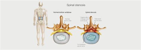 LUMBAR RADICULOPATHY - MOTUS Physical Therapy