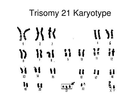 Trisomy 21 Heart Defects