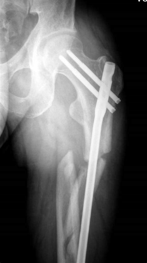 Nonunion Femur Case Dr Mark Brinker Houston Orthopedic Surgeon