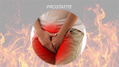 PROSTATA INFIAMMATA COSE LA PROSTATITE Matteo Salvi