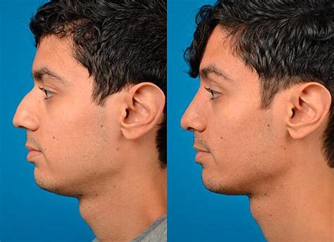 5 Most Popular Facial Plastic Surgery Procedures For Men