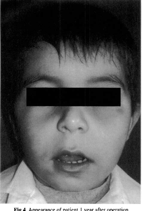 Figure 4 From Rare Case Of Intramasseteric Cavernous Hemangioma In A