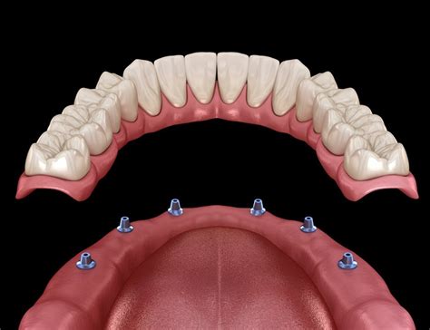 Les Dentiers Clips S Sur Implants En Turquie Une Solution Moderne