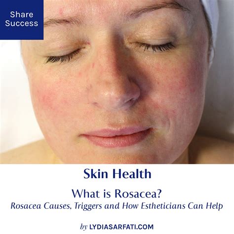 What Is Rosacea Rosacea Causes Triggers And How Estheticians Can Help