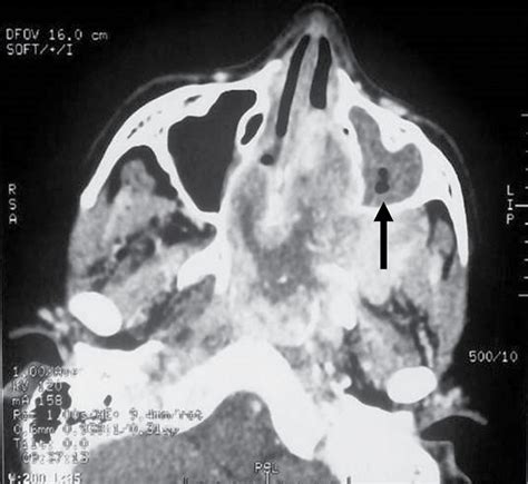 Angiofibroma nasofaríngeo juvenil