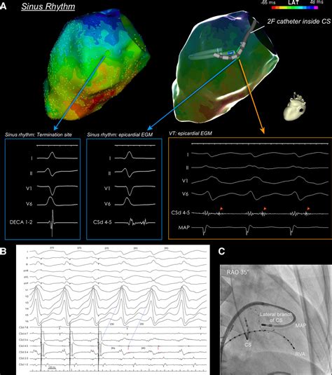 Rotational Activation Pattern During Functional Substrate Mapping Novel Target For Catheter