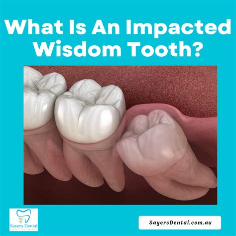 Wisdom Teeth Removal How To Prep And Recovery Tips Artofit