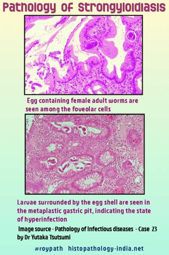 Pathology Of Strongyloidiasis Dr Sampurna Roy Md