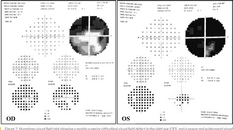 Figure From Sudden Visual Loss Due To Arteritic Anterior Ischaemic