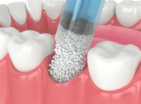 Dental Bone Graft - Bone Graft for Dental Implant