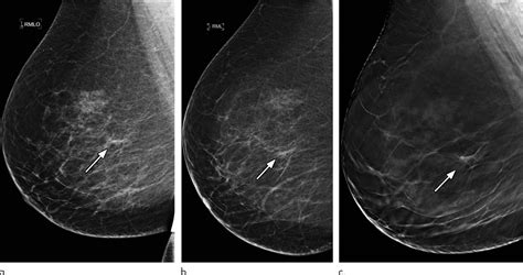 3d Mammography Significantly R [image] Eurekalert Science News Releases