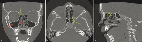 20 Sinuses Radiology Key