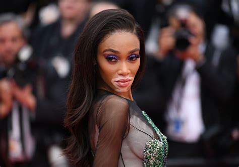 Winnie Harlow Sur Son Vitiligo Je Me Fous Que Vous Me Trouviez