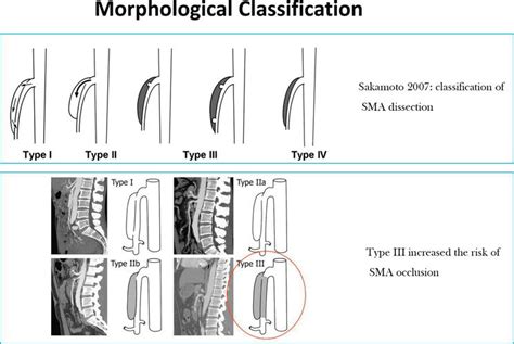 Endovascular Treatment For Acute Mesenteric Ischemia Intechopen