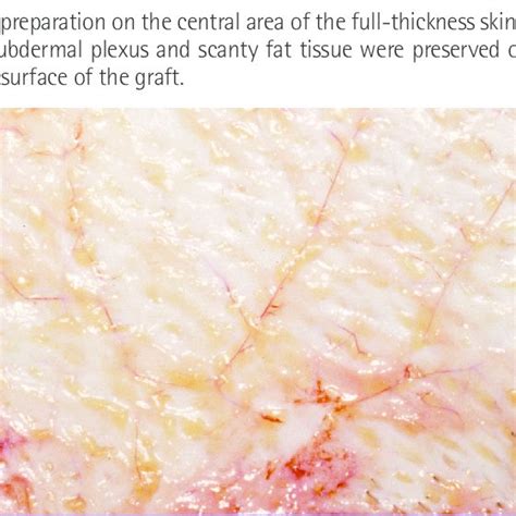 Pdf Full Thickness Skin Grafting With De Epithelization Of The Wound