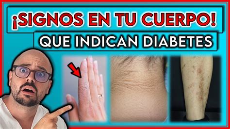 7 Signos Visibles En Tu Cuerpo Que Indican Diabetes ¡así Comienza La