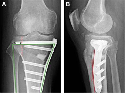 Open Wedge High Tibial Osteotomy With Pes Anserinus Preservation And