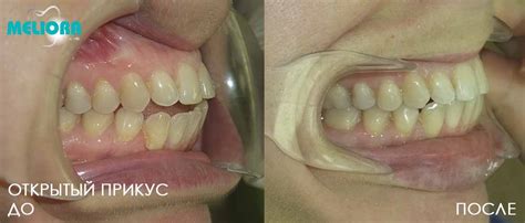 Исправление прикуса в Москве - цены от 8000 рублей