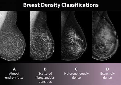 Breast Density In Enid Ok St Mary S Regional Medical Center