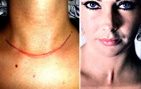 Tracheostomy Scar Revision