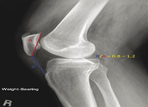 Patella Baja In Total Knee Arthroplasty JAAOS Journal Of The