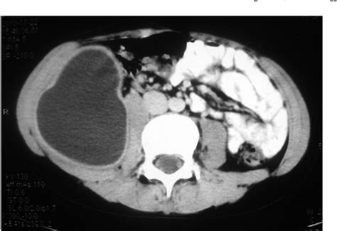 Figure From Case Report Of Primary Retroperitoneal Hydatid Cyst