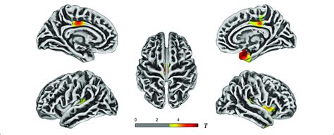 T Value Maps Of Brain Regions With Reduced Cortical Thickness In The