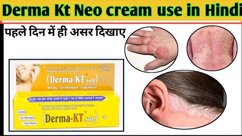 Derma Kt Neo Cream Use In Hindi Allergy Ke Liye Cream Drakeel