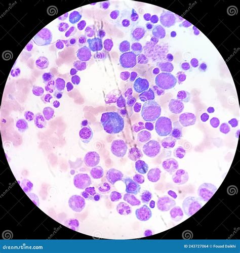 Plasma Cells In Multiple Myeloma Stock Photography | CartoonDealer.com #243727064