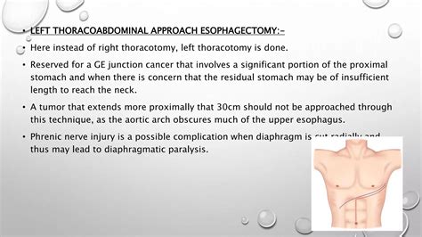 Ivor lewis esophagectomy | PPT