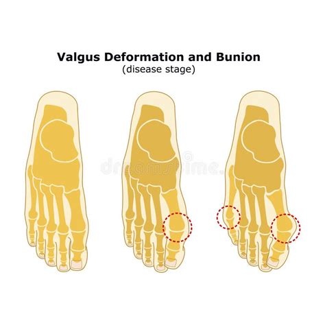 Difformité Dâge Et De Valgus Du Pouce Oignon Étapes Du Développement