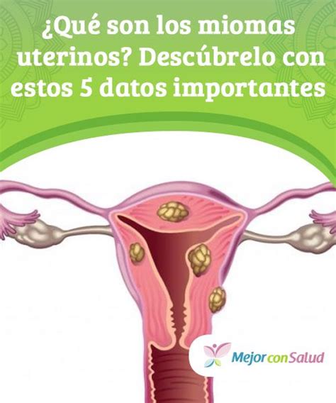 ¿qué Son Los Miomas Uterinos Descúbrelo Con Estos 5 Datos Importantes Curiosidades Miomas