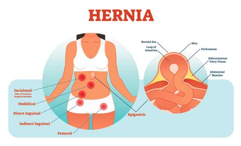 Hernia Overview Orchard Health Clinic Osteopathy Physiotherapy And Chiropractic