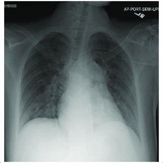 Precardiac Arrest Chest Radiograph Portable Anterior Chest Radiograph